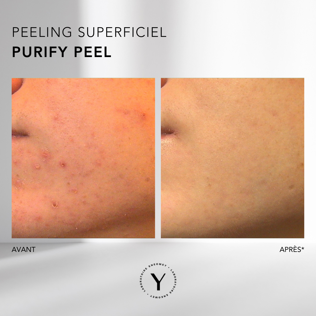 Purify Peel